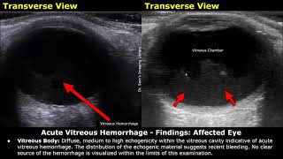 Eye Ultrasound Reporting  Cataract Retinal Detachments Vitreous Hemorrhage USG Case Reports [upl. by Halak]