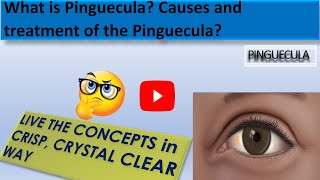 What is Pinguecula  What is the Causes of Pinguecula and the treatment of the Pinguecula [upl. by Ydnew]