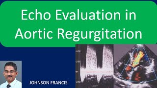 Echo Evaluation in Aortic Regurgitation [upl. by Sregor]