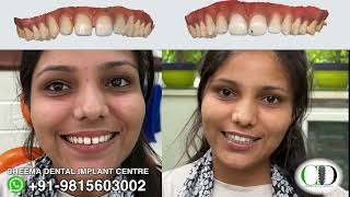 Front Upper Teeth Gap  How the teeth Gaps are filled  Teeth Gap Treatment Jalandhar Dentist [upl. by Yesor138]