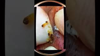 cravos pretos no rosto escreva se no canal para mais vídeos compartilhe acne blackhead [upl. by Ilrahs]