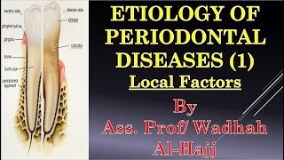 7 Etiology of periodontal diseases1Local factorsDr Wadhah Periodontology lecturesدوضاح الحاج [upl. by Ashraf120]