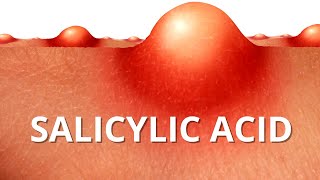 Heres WHY Salicylic Acid is Best For ACNE [upl. by Cummine439]