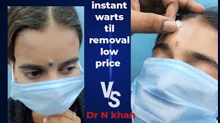 Birthmark til warts removal instant til removal treatment at low price Tophairgrowothinindia wb [upl. by Fiertz]