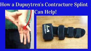 How a Dupuytrens Contracture Splint Helps [upl. by Pearline]