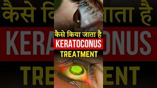 कैसे किया जाता है Keratoconus Treatment [upl. by Ezekiel]