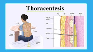 thoracentesis [upl. by Nugent]