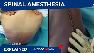 NYSORA Students Educational Videos Spinal Anesthesia [upl. by Neened]