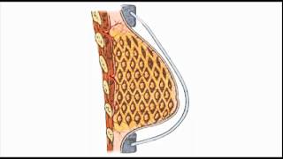 Breast Reconstruction after Mastectomy using BRAVA with Fat Transfer [upl. by Dwayne84]