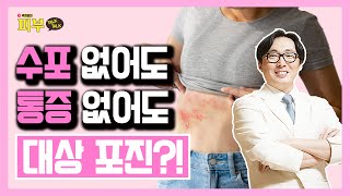 ‘대상 포진’에 대한 오해와 진실 후유증 없애는 치료 포인트는  박치영의 피부 톡톡 76 대상포진 [upl. by Nitsu191]