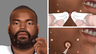 ASMR Shaving Ingrown hair Removal Animation  Relaxing Animation [upl. by Aneehsram608]