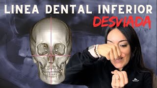 ¿Sonrisa Desviada  Las Causas de la linea media inferior desviada [upl. by Skvorak]