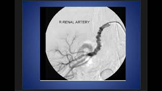 Case Discussion  Fibromuscular dysplasia of Right Renal Artery [upl. by Onafets312]