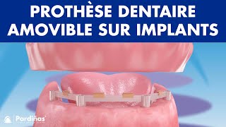 Prothèse dentaire amovible sur implants © [upl. by Marianne]