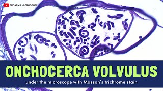 Onchocerca volvulus under the microscope with Massons trichrome stain [upl. by Akimyt]