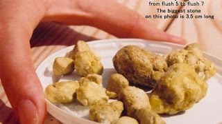 Liver Detoxify Gall Stone Cleanse Removal Of Gallstones Gallstone Attacks [upl. by Eiveneg]