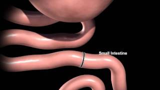 Rex Bariatrics Gastric Bypass Surgery Explained [upl. by Oberon403]