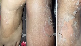 Body Chemical Peel At Home [upl. by Alletsirhc]