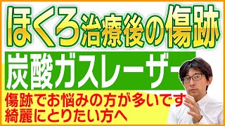 【ほくろ除去の傷跡が気になる方必見！！！】傷跡専門の形成外科での炭酸ガスレーザーCO2レーザーついて【きずときずあとのクリニック】 [upl. by Ahseuqram21]