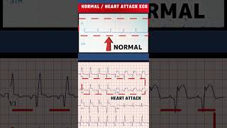 हार्ट अटैक का ECG  HEART ATTACK ECG VS NORMAL ECGshorts [upl. by Culliton]