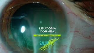 Leucoma Corneal [upl. by Haidej157]