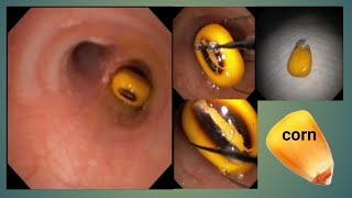 Pediatric Foreign Body Removal Of Corn l শিশুর ফুসফুস থেকে ভুট্টা দানা বের করা হলো BDENDOSCOPY [upl. by Declan]