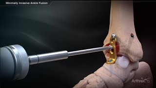 Minimally Invasive Ankle Fusion [upl. by Ahsinrad]