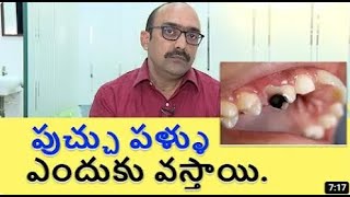 పుచ్చు పళ్ళు ఎందుకు వస్తాయి How to treat cavities know here all detials [upl. by Haley72]