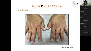 Sospechando artritis psoriásica [upl. by Aztinad]