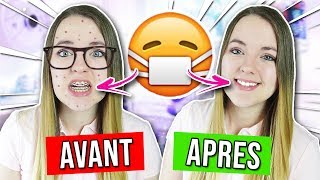 AVOIR UN APPAREIL DENTAIRE  AVANT VS APRES [upl. by Graybill]