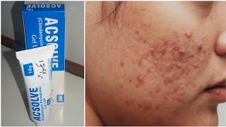 Acne Removal Treatment  Acsolve Gel remove pimples at home [upl. by Anneliese250]