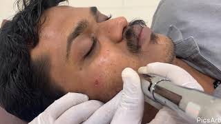 Microneedling Treatment For Chicken Pox Scar Marks On Skin by Dr Vaseem Choudhary [upl. by Analah822]