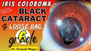 Iris Coloboma with Cataracta Nigra and a Loose Bag Grade 6  Dr Deepak megur [upl. by Husch]