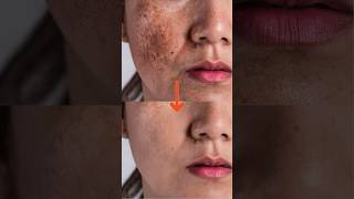 Best Korean Skincare for Acne Scars and Dark Spotsব্রণের দাগ কালো দাগের জন্য কোরিয়ান স্কিনকেয়ার [upl. by Enelad]