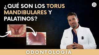 TORUS mandibular y palatino ¿Qué son ¿Cómo tratarlos [upl. by Itsim]