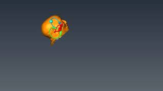 Casani Maneuver for Anterior Canalithiasis Teixido HD [upl. by Anahsed880]