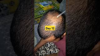 Day 12 of hair loss recovery journey  traya review  hair loss problem hairloss hairregrowth [upl. by Acimat]