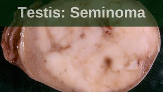 Testicular germ cell tumours  Seminoma  Pathology mini tutorial [upl. by Ayekal365]