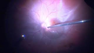 Surgery Vitrectomy for Retinal Detachment Assortment of Cases [upl. by Noteek]