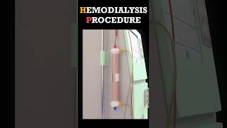 Hemodialysis Procedure shorts dialysis [upl. by Demha]