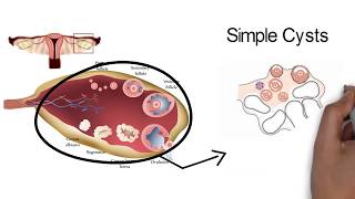 OVARIAN CYSTSwhat you need to know [upl. by Britta441]