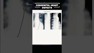 Congenital Heart Defects nursescongenitaheartdefects abnormalities doctorneetmbbsbscnursing [upl. by Red]