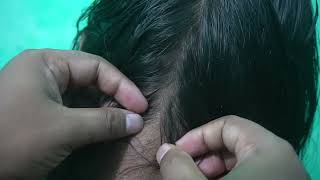 Lice Infested Catching and Popping Sounds  ASMR Lice Picking In My Head [upl. by Tymes]