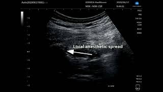 Modified subcostal QL block for postoperative analgesia  Supplementary video 2 ID 306696 [upl. by Benito]