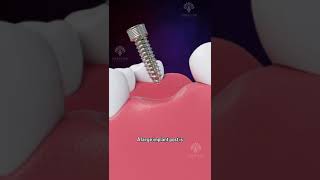 Bone Grafting for Dental Implants shorts facts  creativelearning3d [upl. by Erodeht]