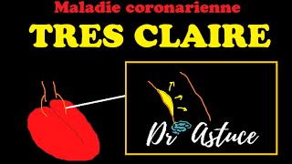 La maladie coronarienne Crise Cardiaque expliquée TRES CLAIREMENT  Dr Astuce [upl. by Akeinahs476]