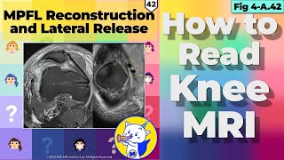 Fig 4A42 MPFL Reconstruction and Lateral Release [upl. by Ennaoj]