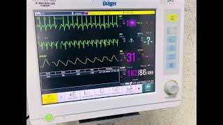 Taquicardia Supraventricular Paroxistica TSVP [upl. by Akcimehs]