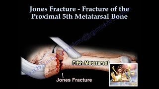 Metatarsal Stress Fractures  Causes Treatment Prevention [upl. by Daenis]