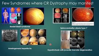 Cone Rod Dystrophy [upl. by Culosio]